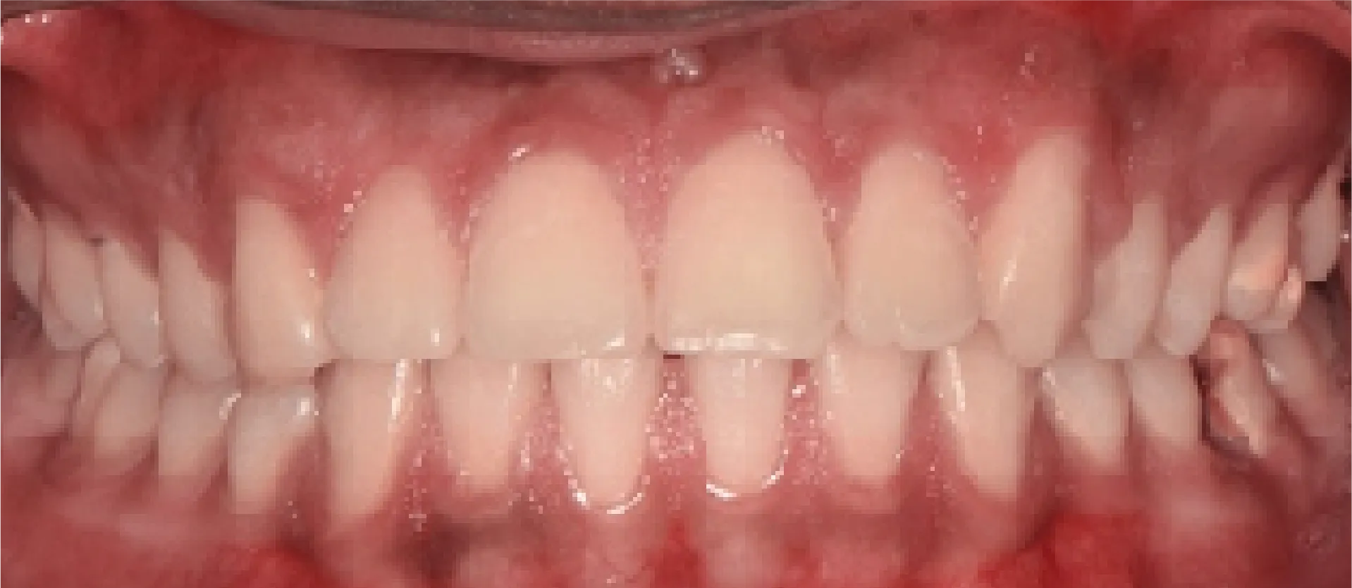 Natural-looking closed gap after composite bonding