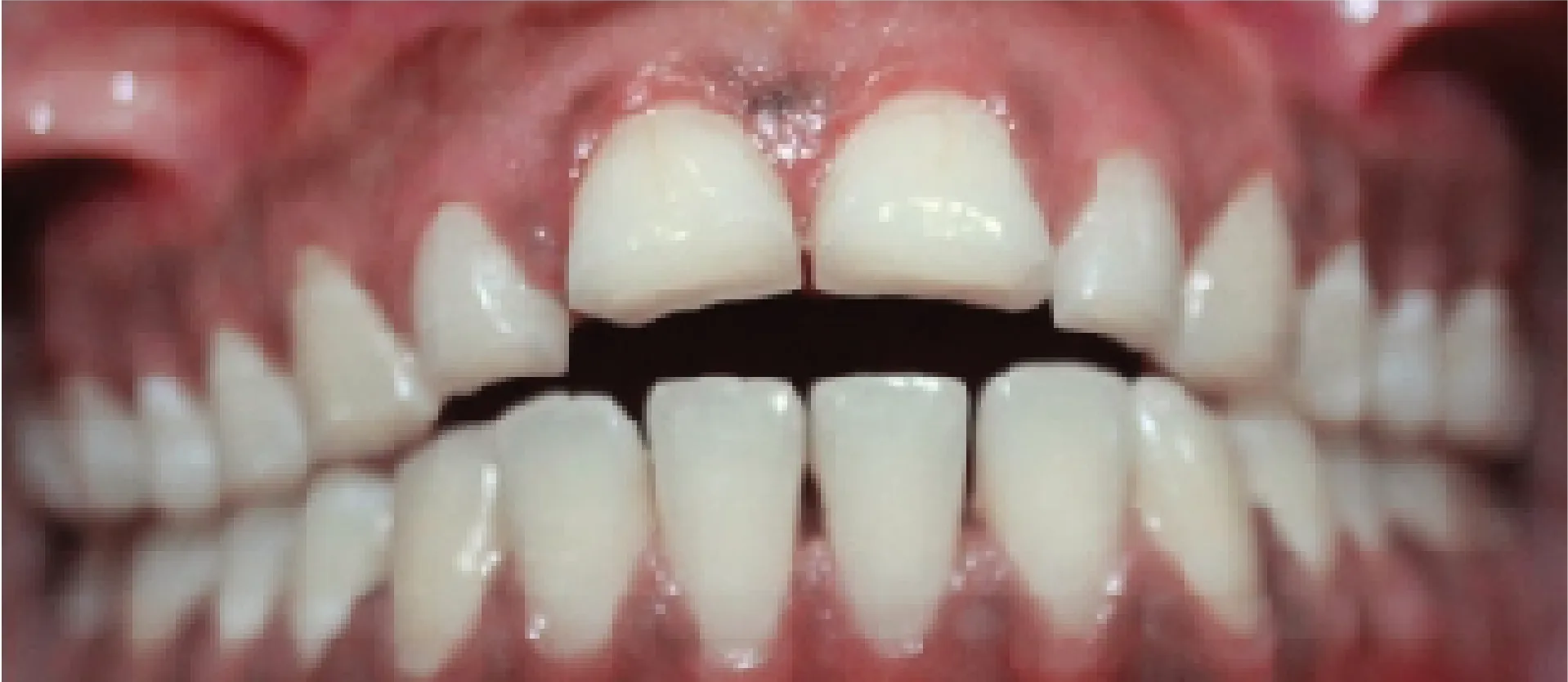 Crowded, misaligned teeth before orthodontic treatment