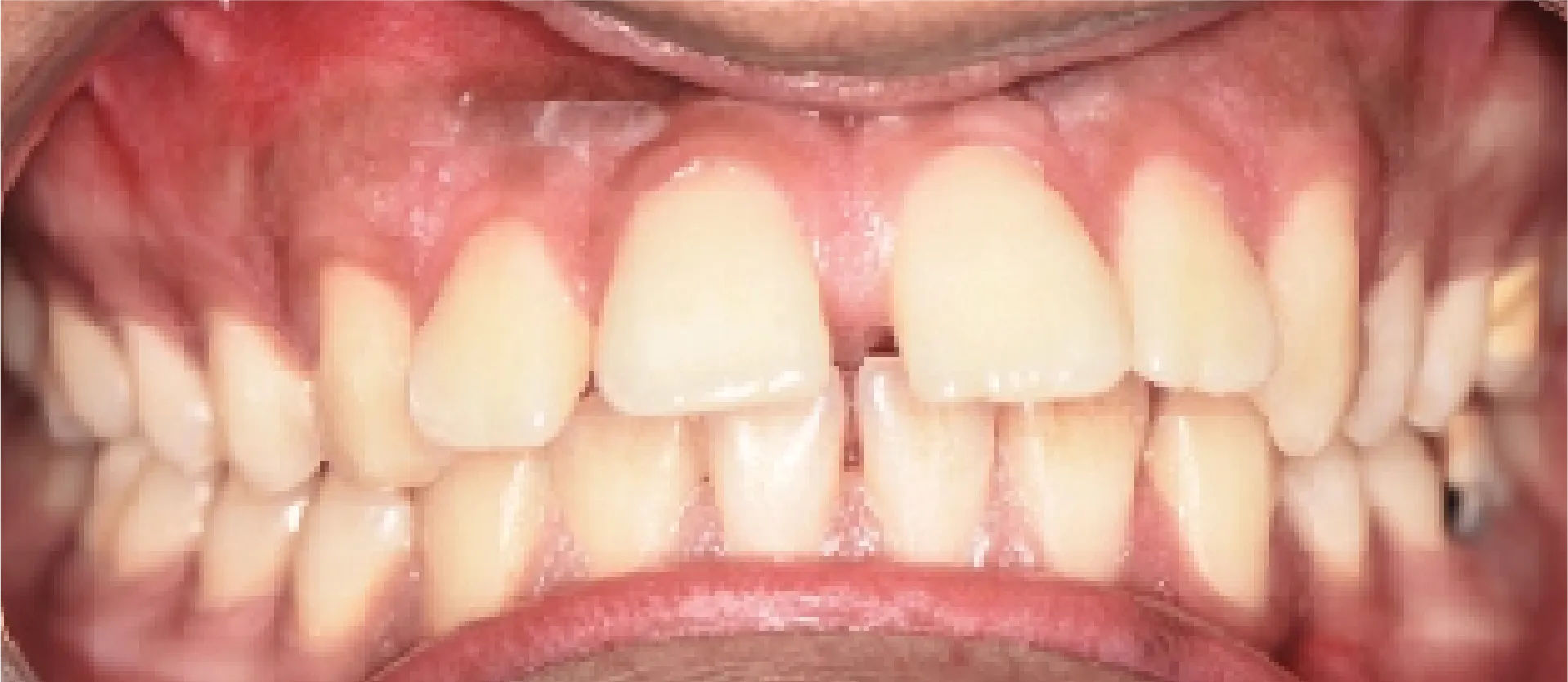 Visible gap between front teeth before treatment