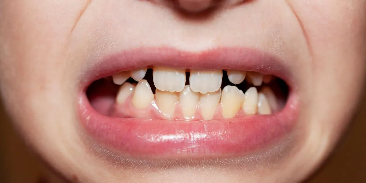 Children dental disorders