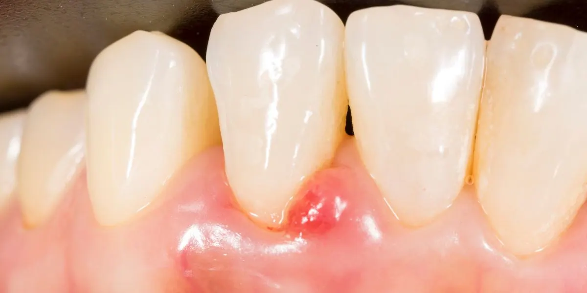 Gingival Recession