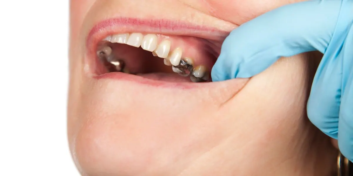 Preventing tooth decay