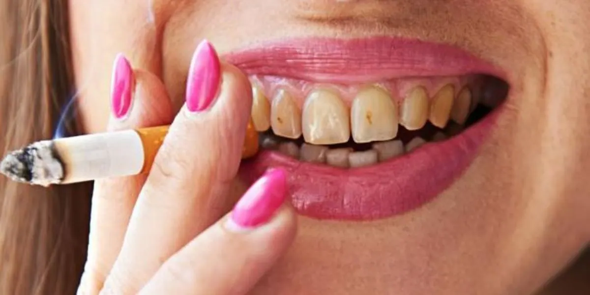 Smoking effects on teeth
