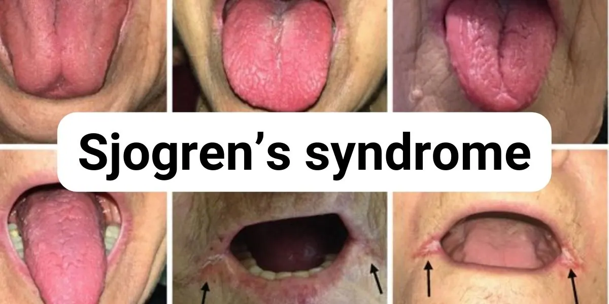 Dry mouth