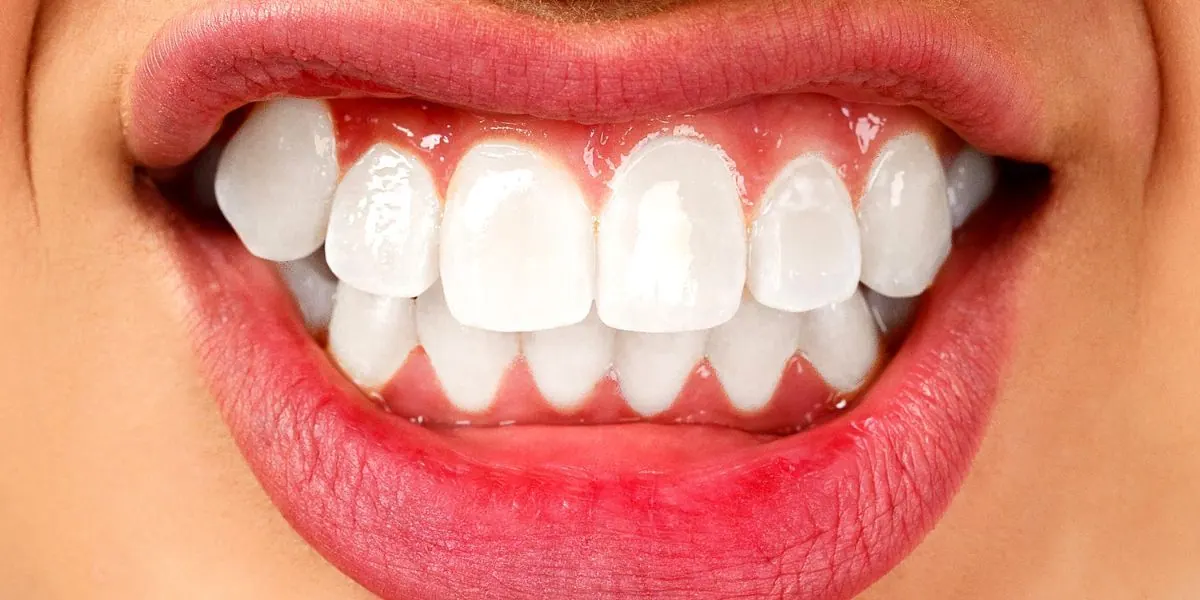 What is bruxism
