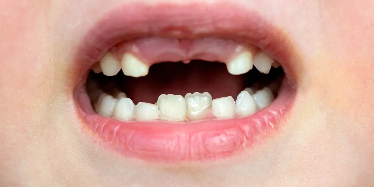 Milk teeth